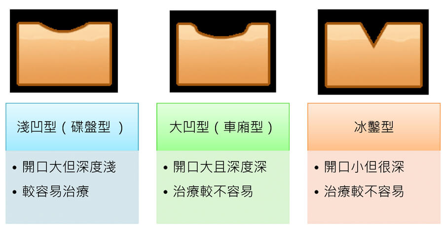 不美觀的痘疤三種類 Image