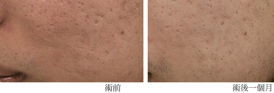 魔點飛梭改善青春痘凹疤